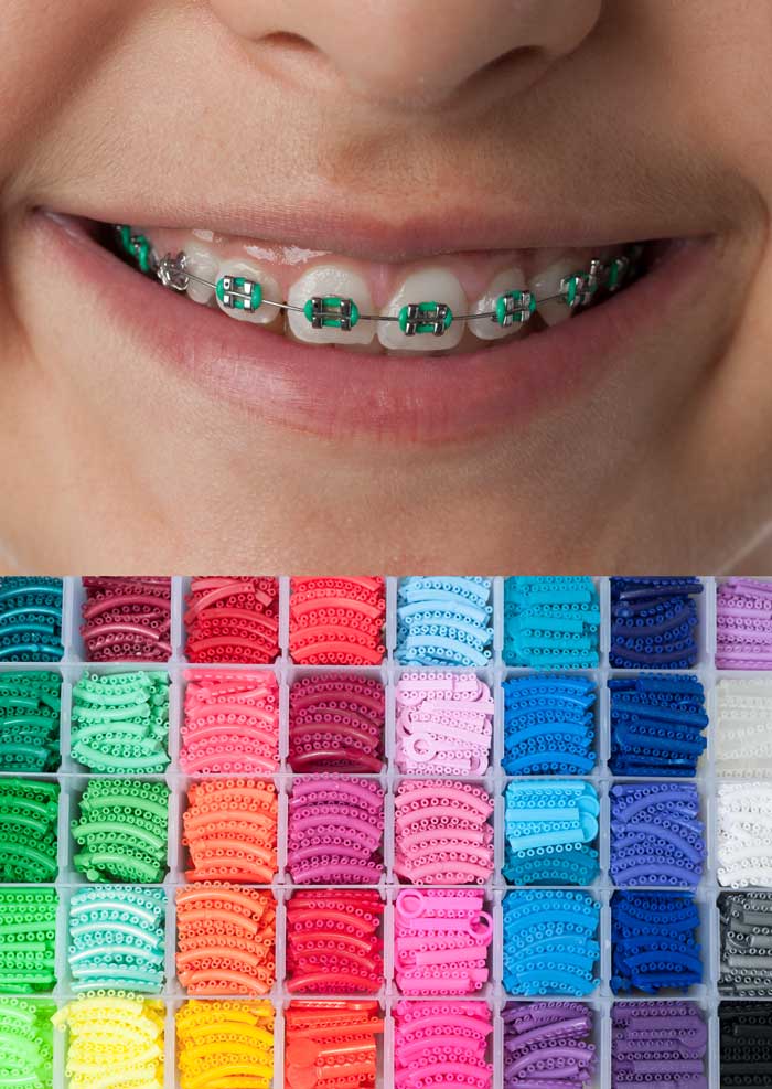 Eating Tips With Braces Braces Colors Dental Cute Combinations Brackets Bright Teeth Getting 